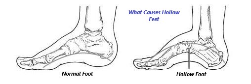 Hollow Feet