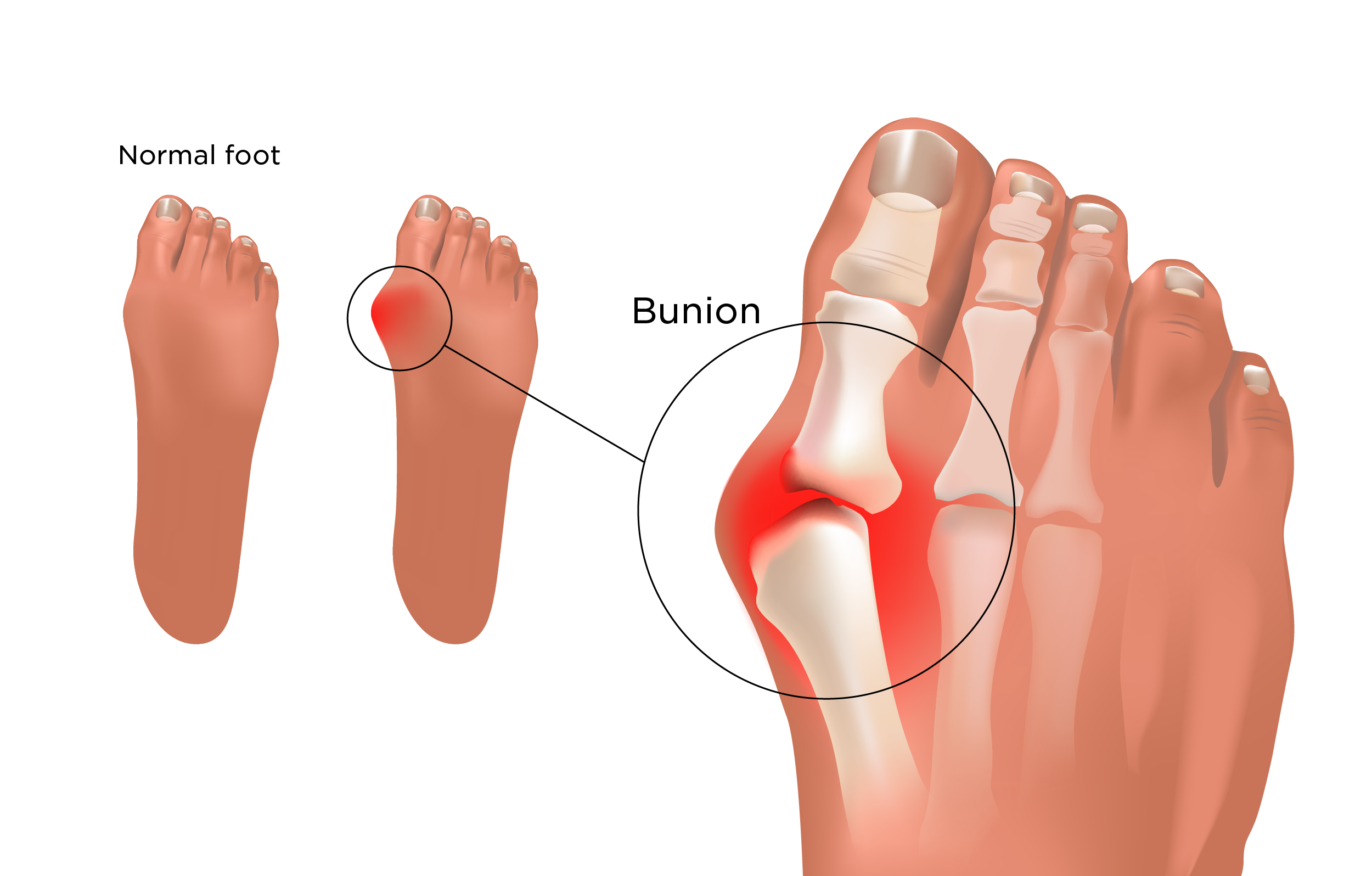 Bunions