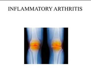 Arthritis