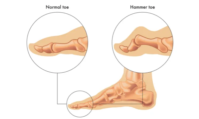 Hammertoes