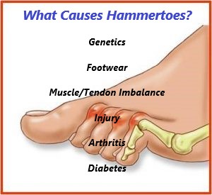 Hammertoes