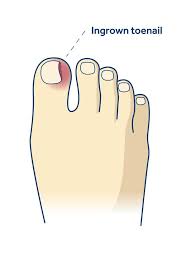 Ingrown Toenails