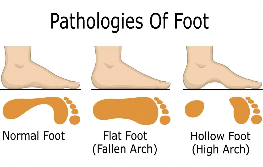 Hollow Feet