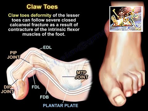 Claw Toes