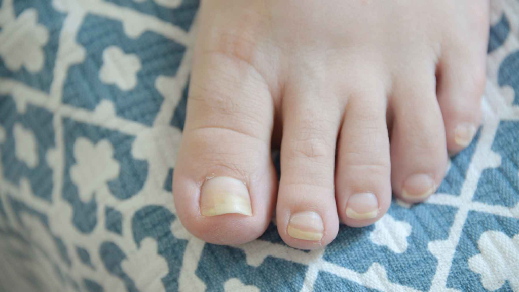 Yellow Nail Syndrome